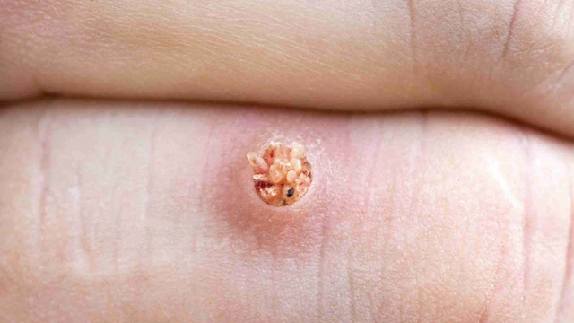 bai-viet/cach-tri-mun-coc-tai-nha-hieu-qua.html