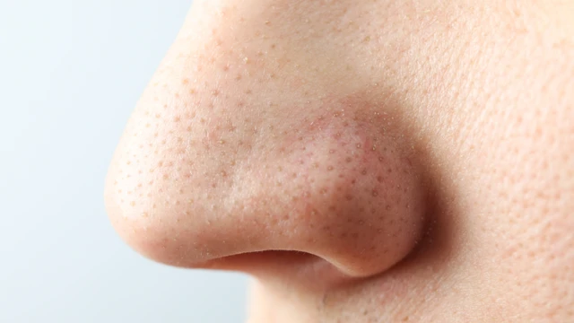 bai-viet/cach-tri-mun-dau-den-o-mui-tai-nha-de-ap-dung.html