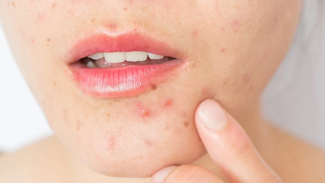 bai-viet/cach-tri-mun-noi-tiet-o-cam-hieu-qua.html