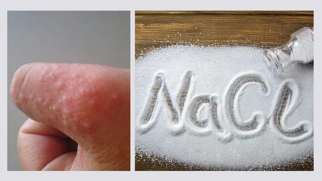 bai-viet/cach-tri-mun-nuoc-o-tay-bang-muoi-nhanh-chong-an-toan-hieu-qua.html