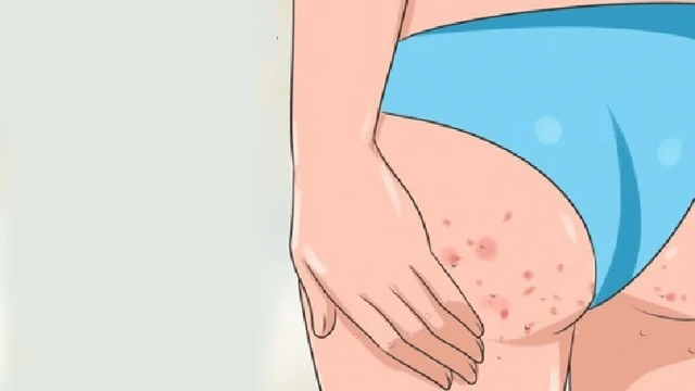 bai-viet/cach-tri-mun-tham-o-mong-don-gian-tai-nha-56756.html