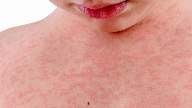 bai-viet/cach-tri-noi-man-ngua-tai-nha-giam-ngua-nhanh-va-an-toan-61501.html