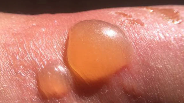 bai-viet/cach-tri-seo-bong-tu-nguyen-lieu-thien-nhien-lanh-tinh-61839.html