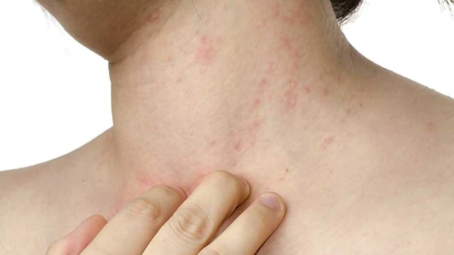 bai-viet/cach-xu-ly-khi-bi-noi-mun-trung-ca-boc-o-co-53612.html