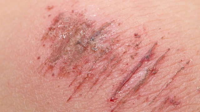 bai-viet/cach-xu-ly-vet-tray-xuoc-da-tai-nha-58145.html