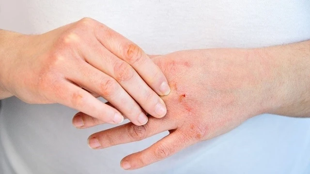 bai-viet/cai-thien-tinh-trang-da-kho-nut-ne-do-thoi-tiet.html