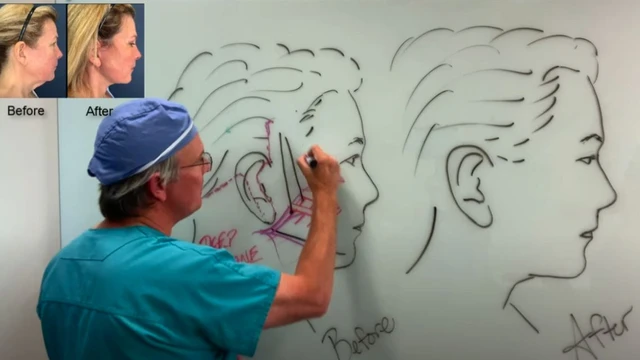 bai-viet/cang-da-mat-smas-loi-ich-nguy-co-va-luu-y-khi-thuc-hien.html