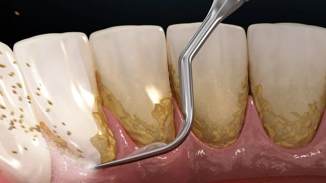 bai-viet/cao-voi-rang-co-anh-huong-gi-khong-loi-ich-cua-viec-cao-voi-rang.html