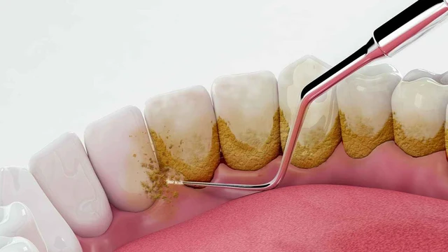 bai-viet/cao-voi-rang-la-gi-loi-ich-cua-viec-cao-voi-rang.html