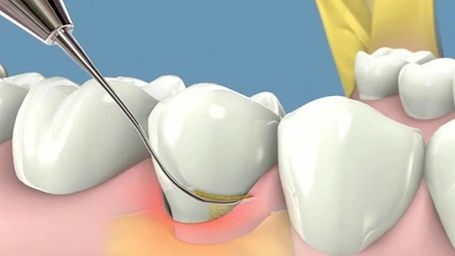 bai-viet/cao-voi-rang-va-tay-trang-rang-cung-luc-co-duoc-khong.html