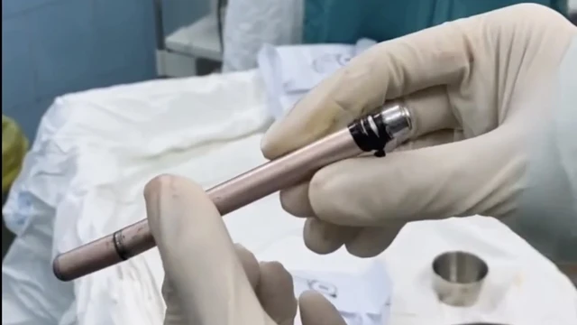 Cấp cứu ban đêm, phát hiện cây bút trong bàng quang thiếu nữ 16 tuổi