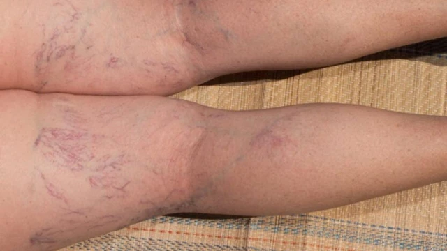 bai-viet/cap-do-suy-gian-tinh-mach-cach-nhan-biet-phan-loai-va-huong-xu-ly-phu-hop.html