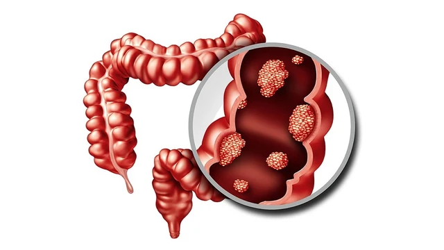 bai-viet/carcinoma-tuyen-biet-hoa-vua-truc-trang-co-che-benh-nguy-co-tien-luong-va-dieu-tri.html
