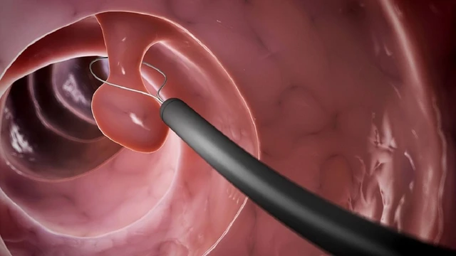 bai-viet/cat-polyp-truc-trang-co-nguy-hiem-khong.html