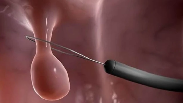 bai-viet/cat-polyp-tu-cung-bao-lau-thi-quan-he-lai-duoc-nhung-luu-y-khi-cat-cat-polyp-tu-cung.html