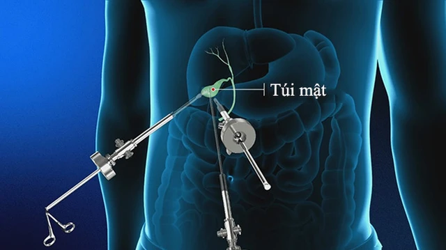 bai-viet/cat-tui-mat-bao-lau-hoi-phuc-nhung-luu-y-sau-khi-phau-thuat.html