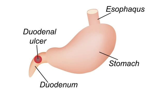 bai-viet/hanh-ta-trang-co-cau-tao-the-nao-cac-benh-ly-lien-quan-den-hanh-ta-trang.html