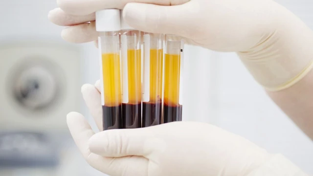 bai-viet/cay-prp-co-bong-da-khong-cach-cham-soc-da-sau-khi-cay-prp.html