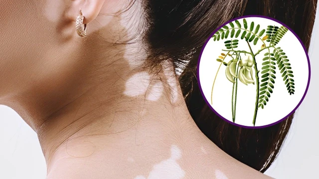 bai-viet/cach-dung-cay-so-dua-tri-lang-beng-mang-den-hieu-qua-cao.html