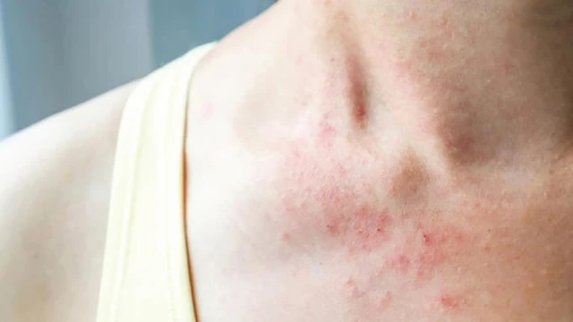 bai-viet/cham-boi-nhiem-co-lay-khong-52956.html