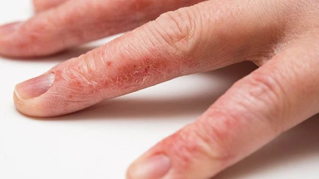 bai-viet/cham-to-dia-co-bi-lay-tu-nguoi-sang-nguoi-khong-52931.html