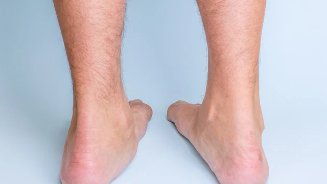 bai-viet/chan-bet-la-gi-nguyen-nhan-nao-gay-ra-chung-ban-chan-bet.html