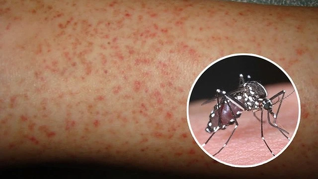 bai-viet/chan-doan-sot-xuat-huyet-dengue-va-dieu-tri-benh.html