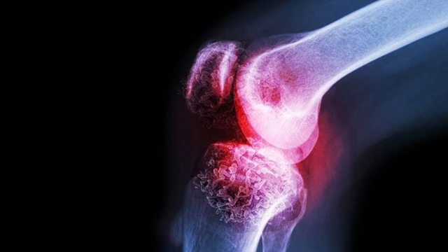 bai-viet/chan-doan-u-xuong-ac-tinh-nho-sinh-thiet-xuong-duoi-cat-lop-vi-tinh.html