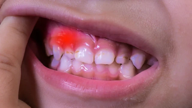 bai-viet/nguyen-nhan-nao-khien-chan-rang-bi-sung.html