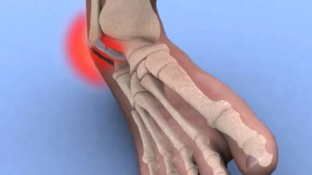 bai-viet/chan-thuong-co-chan-khong-nen-va-nen-an-gi-de-vet-thuong-nhanh-hoi-phuc-54677.html