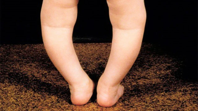 bai-viet/chan-vong-kieng-la-gi-cach-nhan-biet-chan-vong-kieng-o-tre-em-62217.html