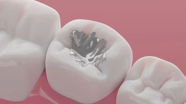 bai-viet/tim-hieu-chi-tiet-ve-cac-chat-han-rang-vinh-vien.html