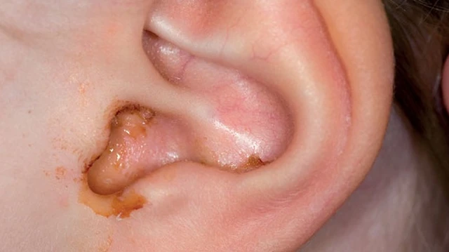 bai-viet/chay-mu-tai-o-tre-em-va-nhung-dieu-ba-me-can-biet-57202.html