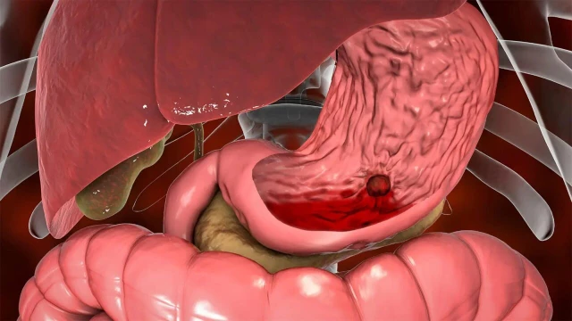 bai-viet/che-do-an-cho-benh-nhan-xuat-huyet-tieu-hoa-ma-nguoi-nha-can-biet.html