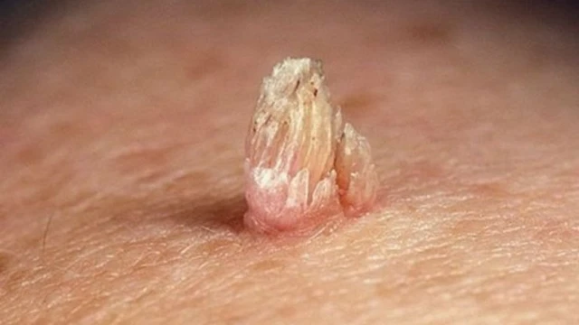 bai-viet/chi-phi-chua-sui-mao-ga-bao-nhieu-tien.html