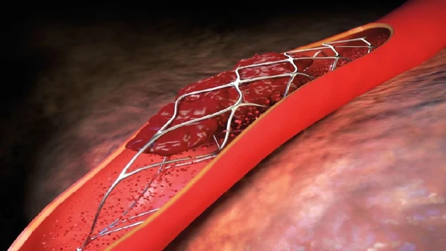 bai-viet/chi-phi-dat-stent-co-bao-hiem-y-te-het-bao-nhieu.html