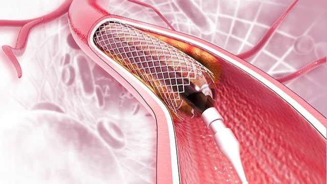 bai-viet/chi-phi-dat-stent-mach-vanh-co-mac-khong.html