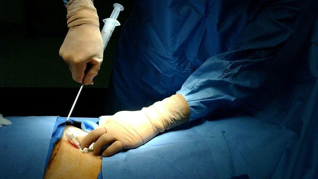 bai-viet/chi-phi-ghep-tuy-o-viet-nam-la-bao-nhieu-sau-khi-ghep-tuy-co-bien-chung-nao-khong.html