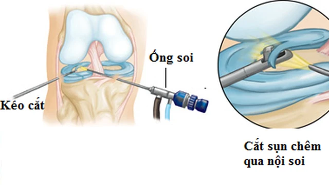 bai-viet/chi-phi-mo-rach-sun-chem-het-bao-nhieu-57565.html