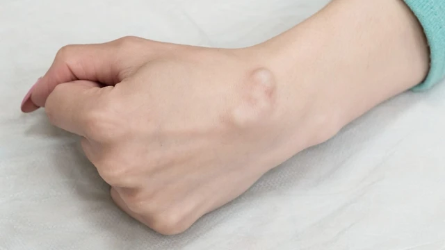 bai-viet/tham-khao-chi-phi-mo-u-nang-bao-hoat-dich-va-nhung-luu-y-quan-trong-sau-khi-mo.html