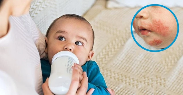 bai-viet/chi-phi-xet-nghiem-di-ung-dam-sua-bo-cach-xu-ly-khi-tre-di-ung-61853.html