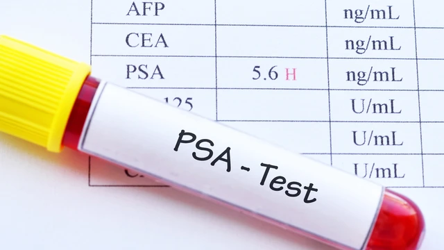 Chỉ số PSA là gì? Khi nào nên thực hiện xét nghiệm PSA?