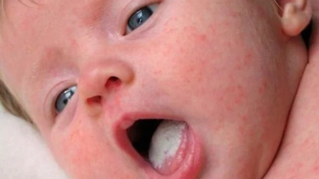 bai-viet/chi-tiet-ve-thuoc-nam-mieng-daktarin-va-huong-dan-su-dung-59885.html