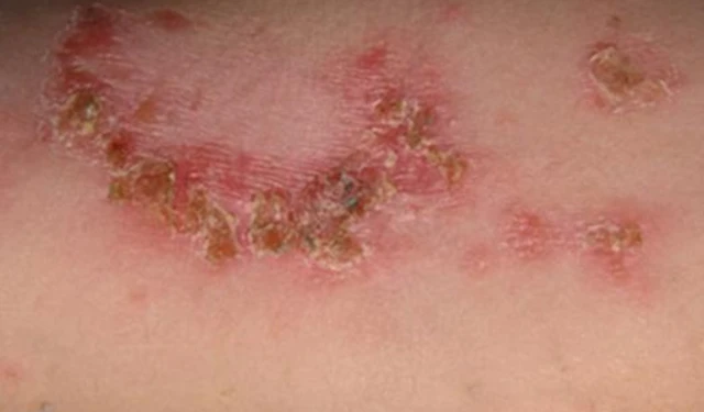 bai-viet/choc-lo-o-mong-phai-lam-sao-de-nhanh-khoi-57052.html