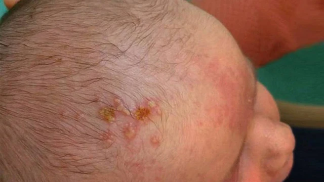 bai-viet/choc-lo-tren-dau-co-nguy-hiem-khong-nguyen-nhan-va-cach-chua-tri-59590.html