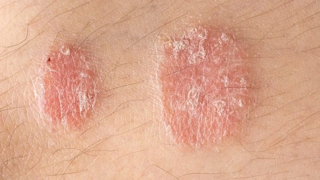 bai-viet/chua-hac-lao-bang-nuoc-dieu-co-thuc-su-hieu-qua.html