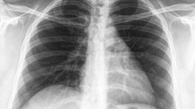 bai-viet/chup-x-quang-viem-phoi-do-phe-cau-la-gi-khi-nao-can-chup.html