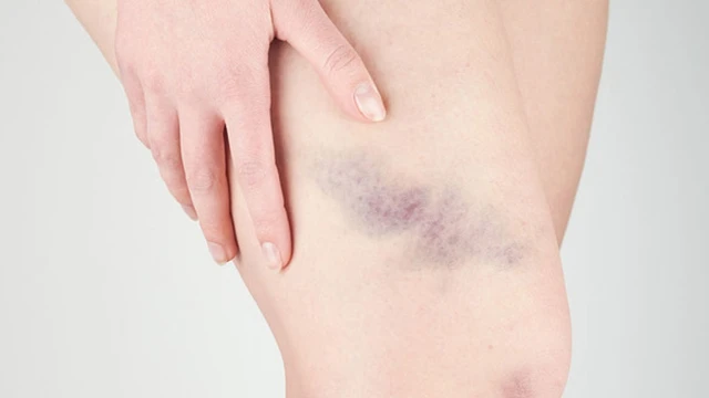 bai-viet/co-nen-chuom-nong-de-tan-mau-bam-hay-khong-68840.html