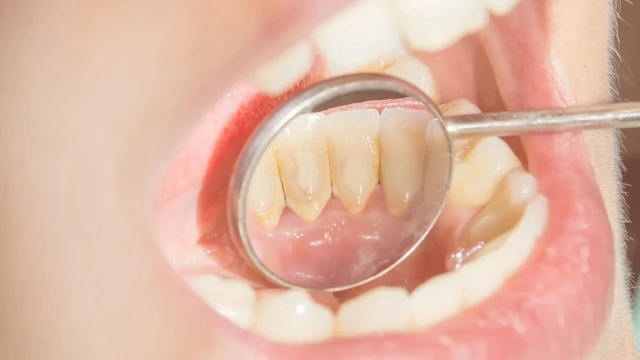 bai-viet/co-nen-lay-cao-rang-khong-mot-so-loi-ich-khi-lay-cao-rang.html