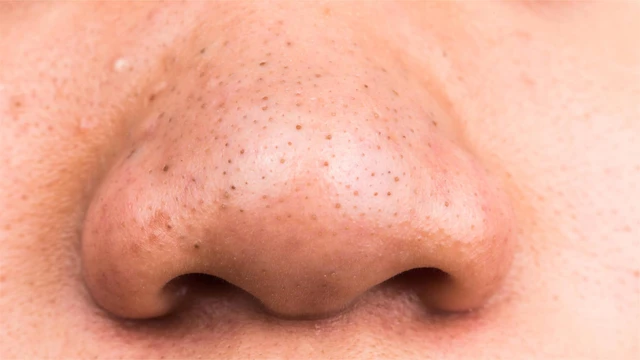 bai-viet/cach-nan-mun-dau-den-khong-de-lai-seo-tai-nha-ban-co-the-tham-khao.html